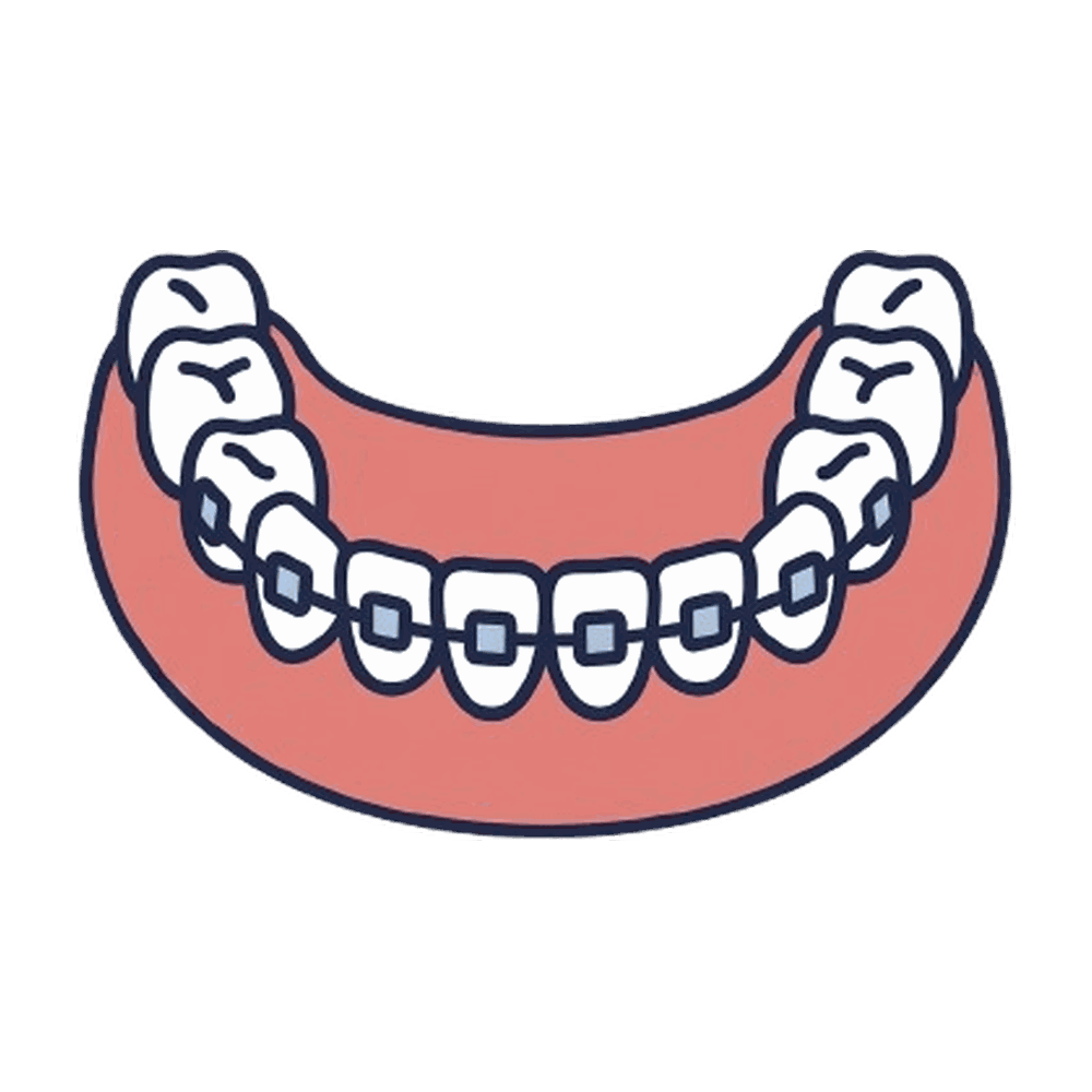 ワイヤー矯正（ブラケット）の歯列のイラスト素材