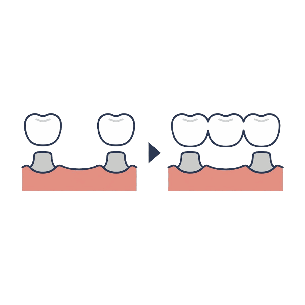 歯の欠損をブリッジで補う仕組みのイラスト素材