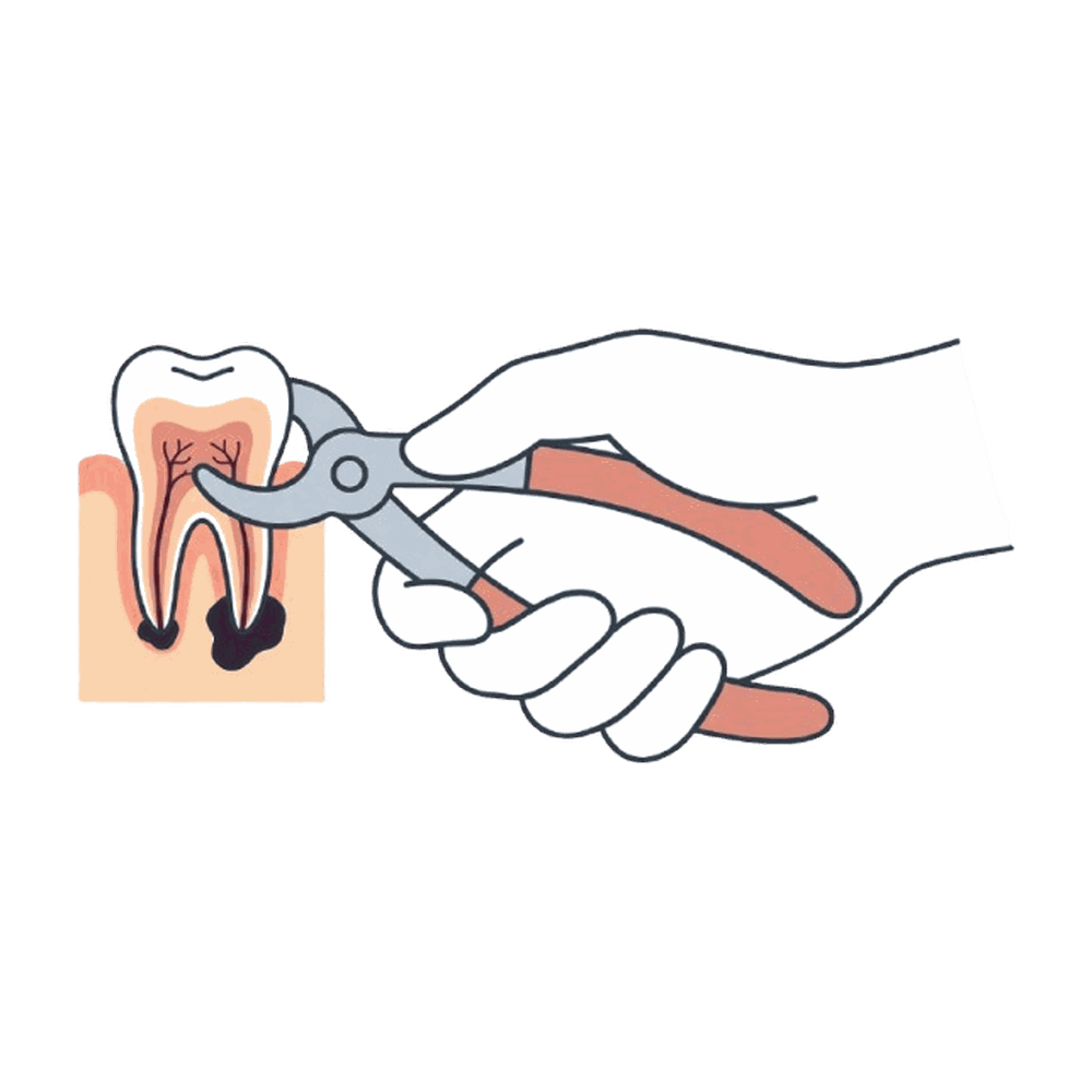 鉗子で歯を抜く処置のイラスト素材