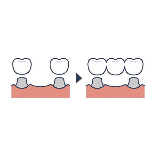 歯の欠損をブリッジで補う仕組みのイラスト素材
