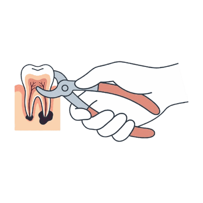 鉗子で歯を抜く処置のイラスト素材